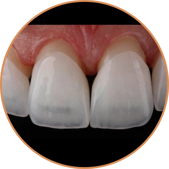 Lentes de contato de porcelana