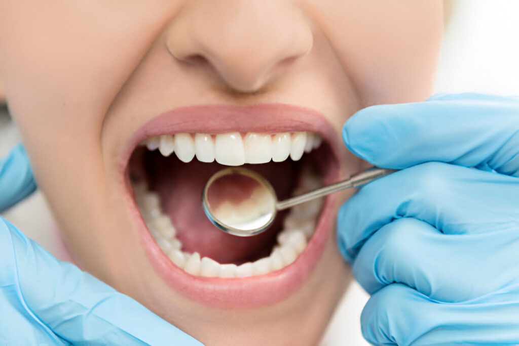 Principais Benefícios do Clareamento Dental