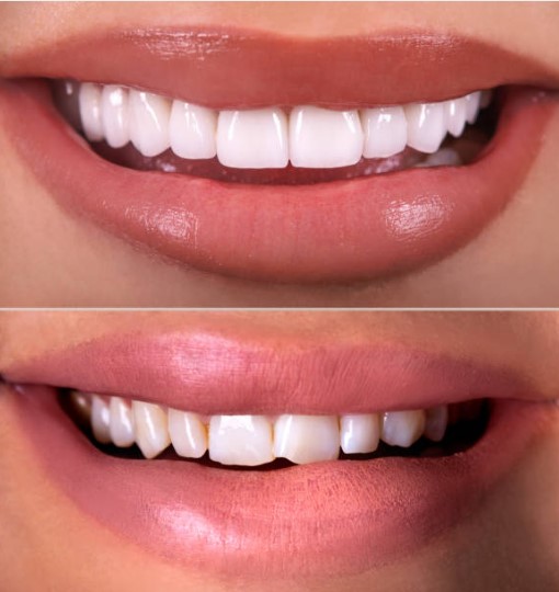 Restauração de dente