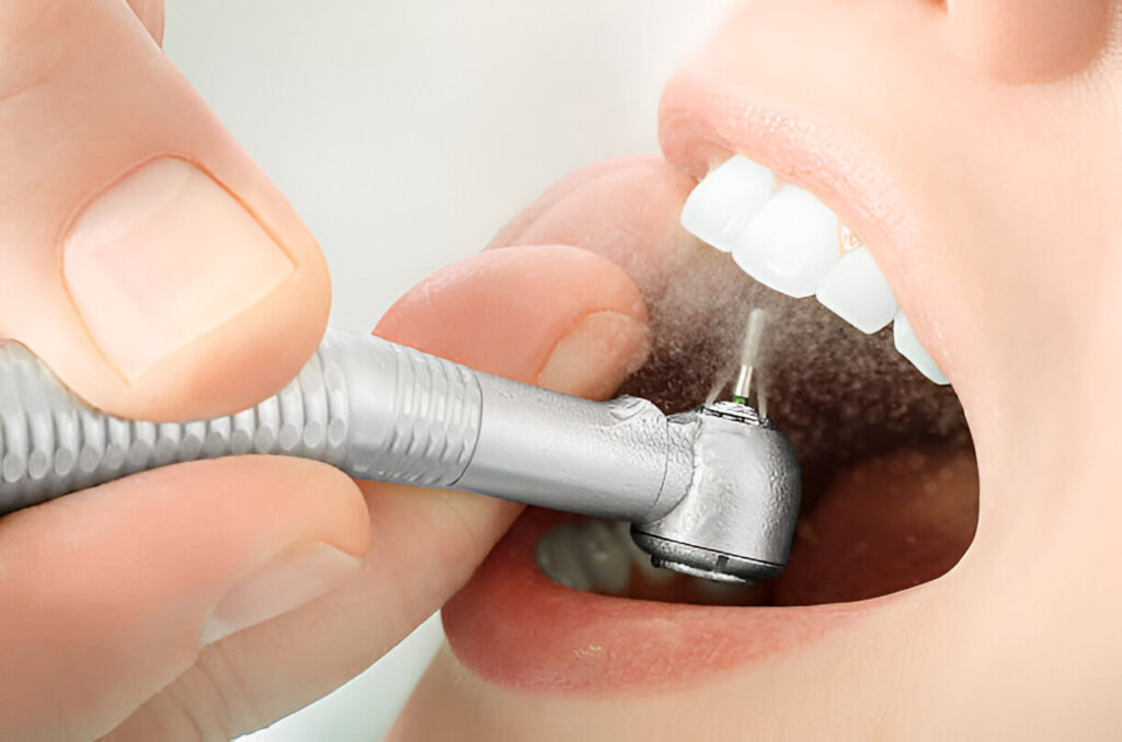 limpeza dentária
